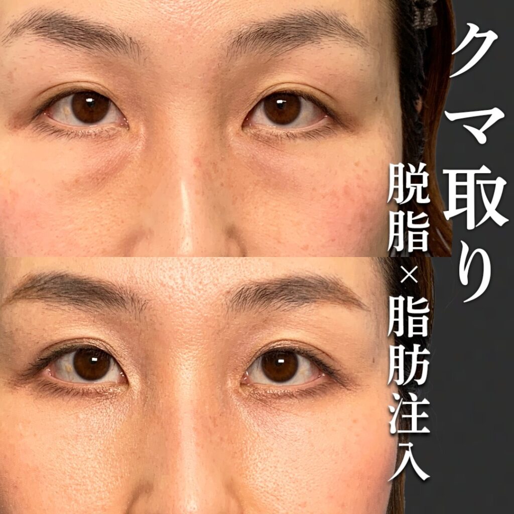 脱脂と脂肪注入の症例写真 (16)
