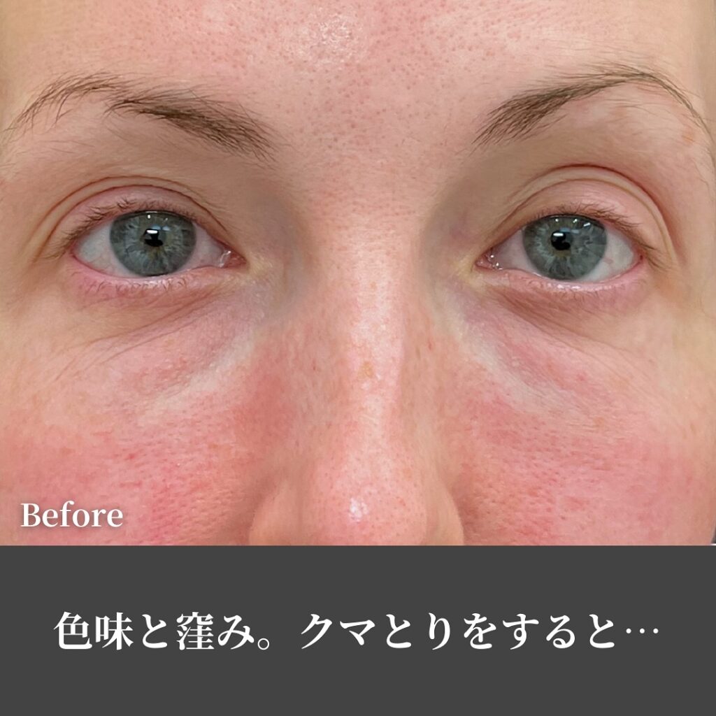 脱脂と脂肪注入の症例写真 (34)