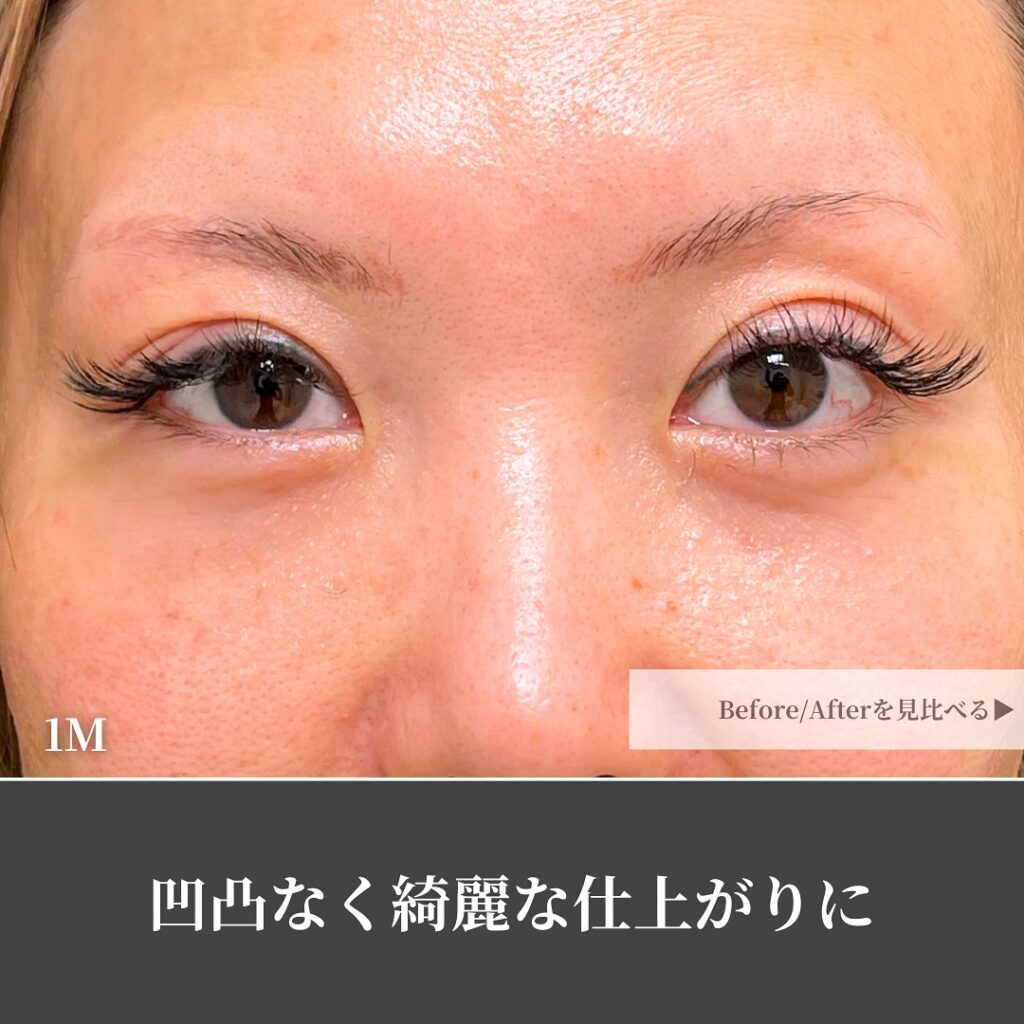 脱脂と脂肪注入でクマを改善した女性の症例 (2)