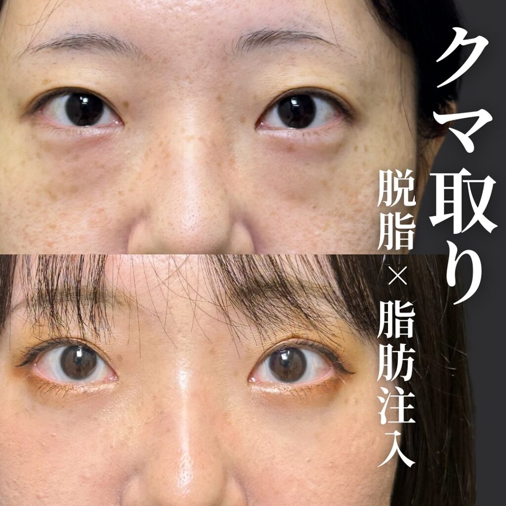 脱脂と脂肪注入の症例写真 (35)