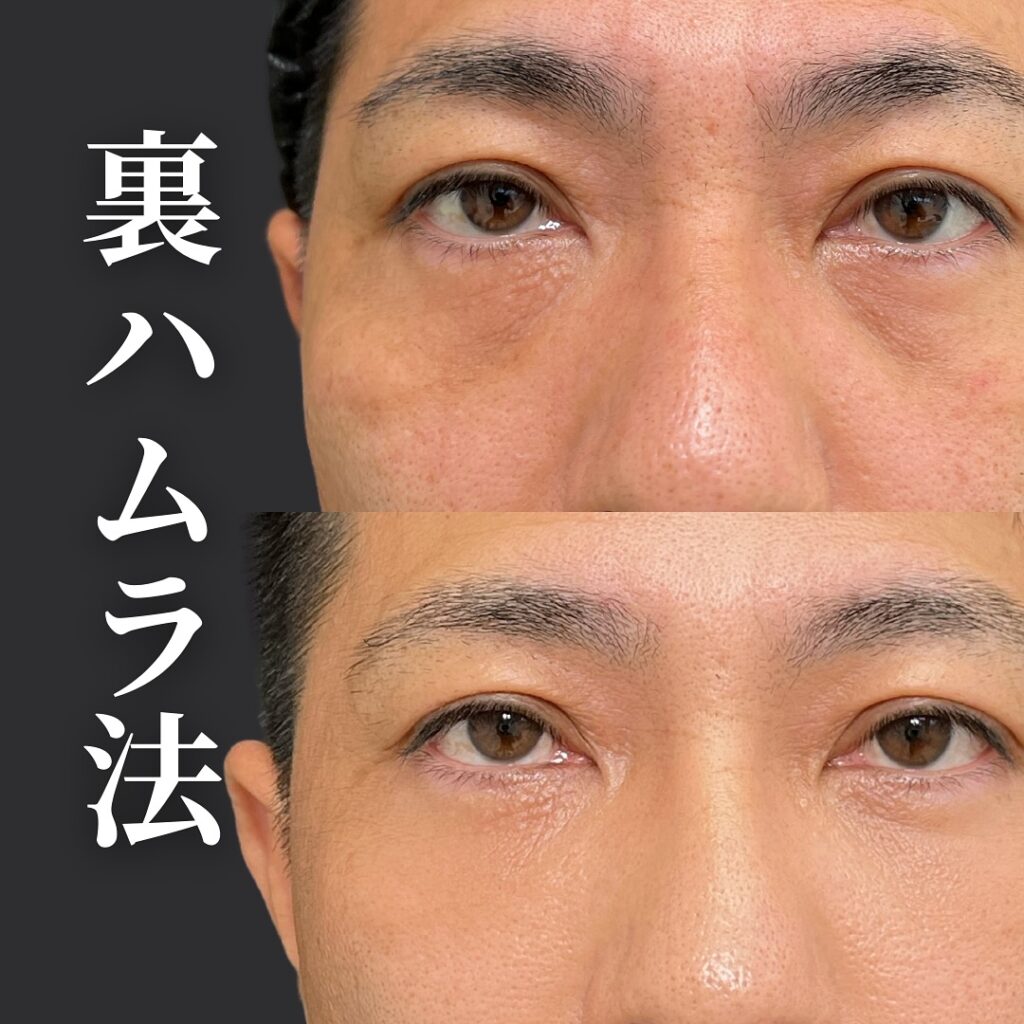 裏ハムラ法の症例写真 (61)