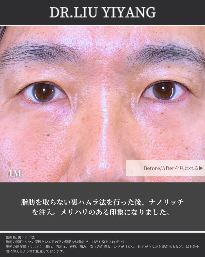裏ハムラ法とナノリッチの症例写真 (23)
