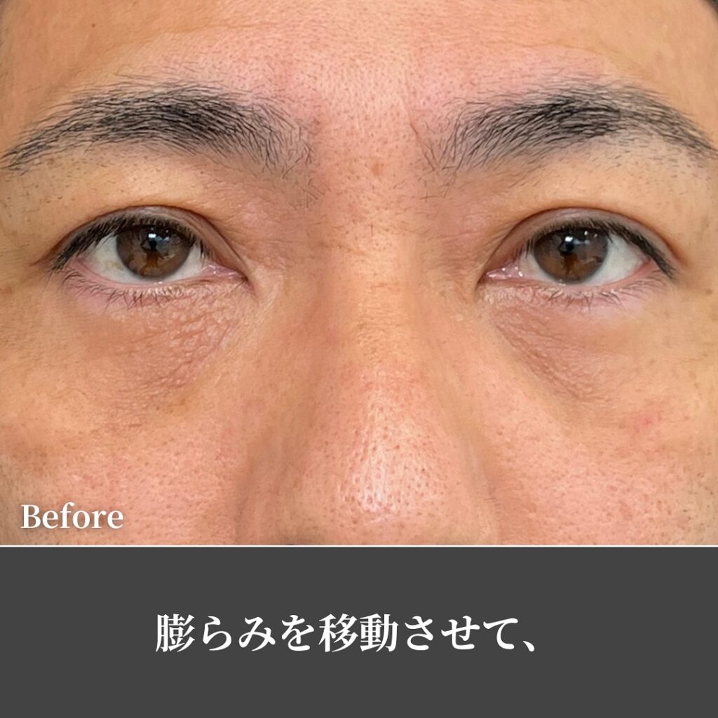 裏ハムラ法の症例写真 (60)