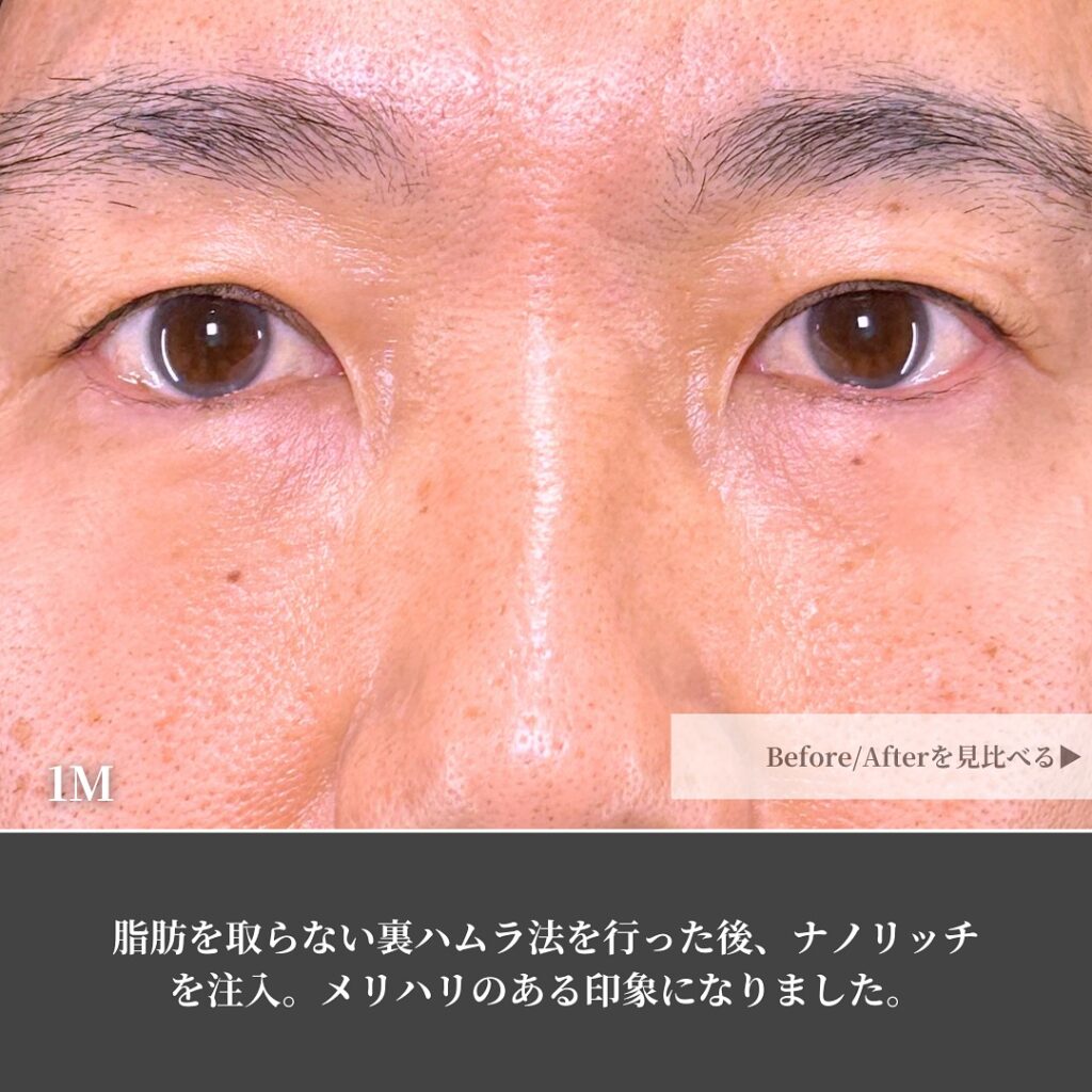裏ハムラとナノリッチの症例写真 (7)