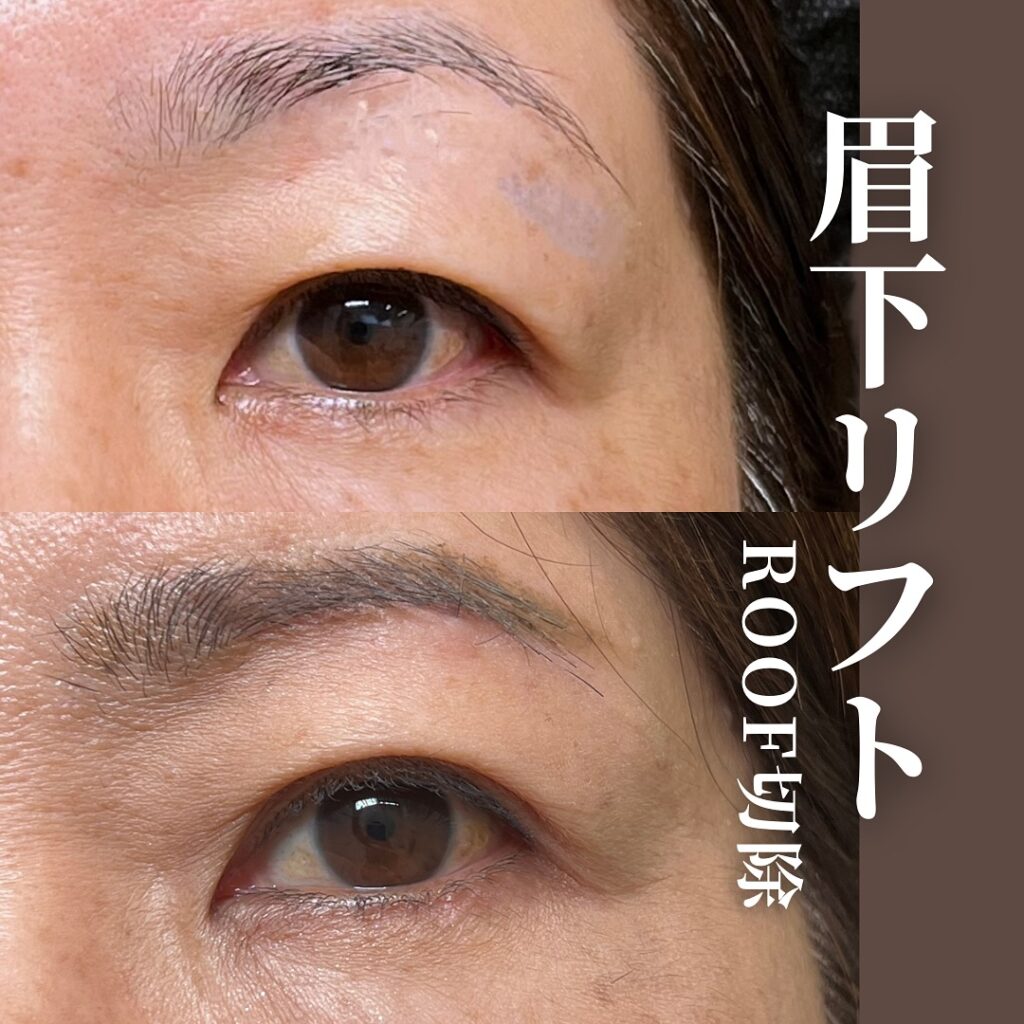 眉下切開の症例 (2)