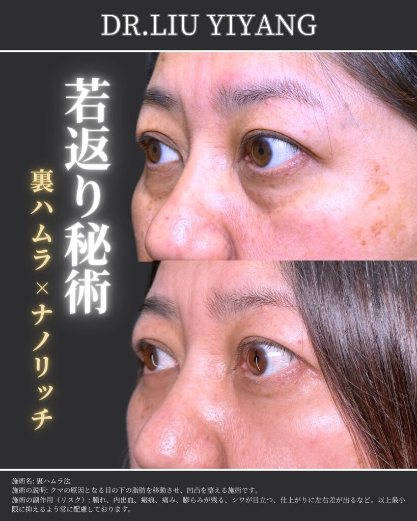 裏ハムラ法とナノリッチの症例 (1)