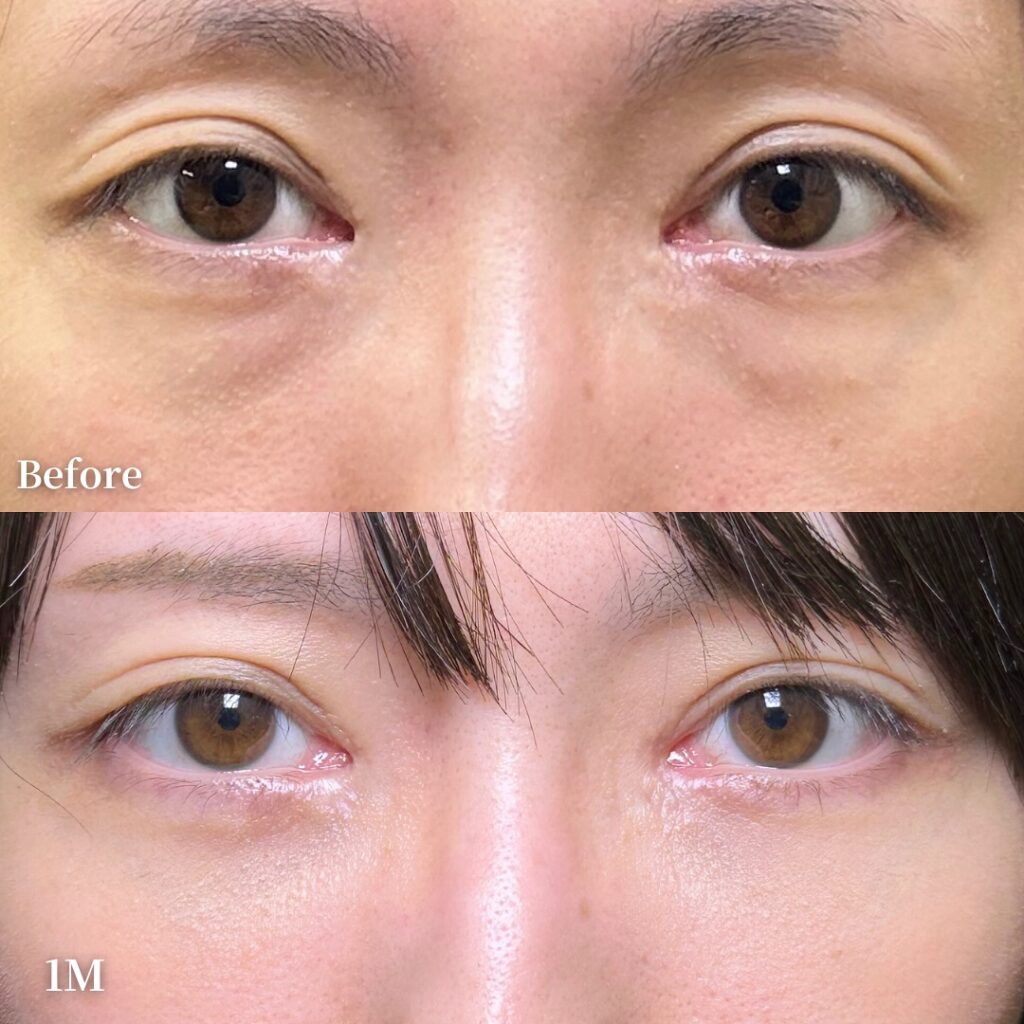 脱脂と脂肪注入でクマを改善した男性の症例写真 (2)