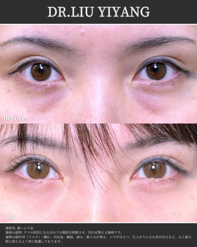 裏ハムラ法とナノリッチの症例写真 (31)