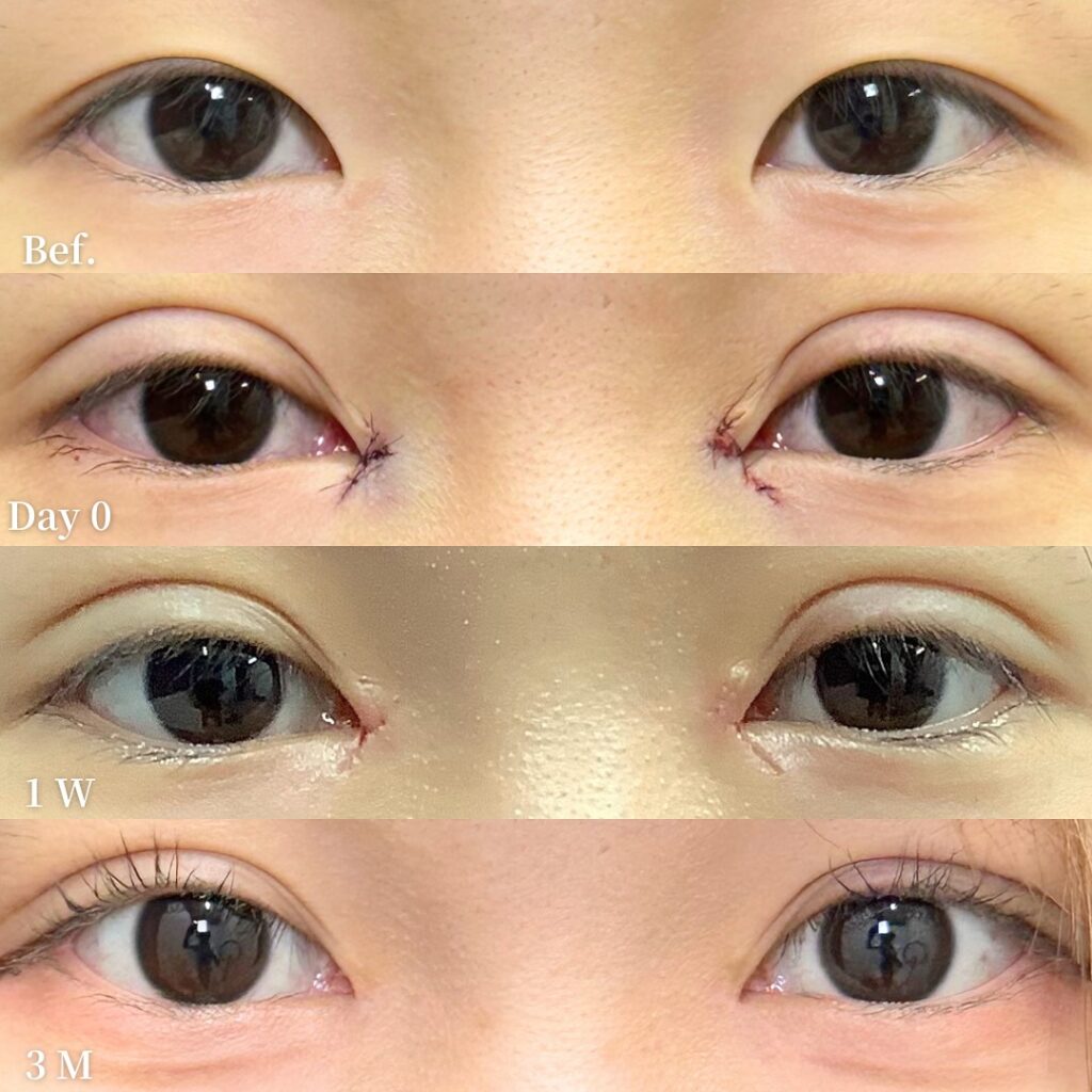 自然癒着法と目頭切開の症例写真 (11)