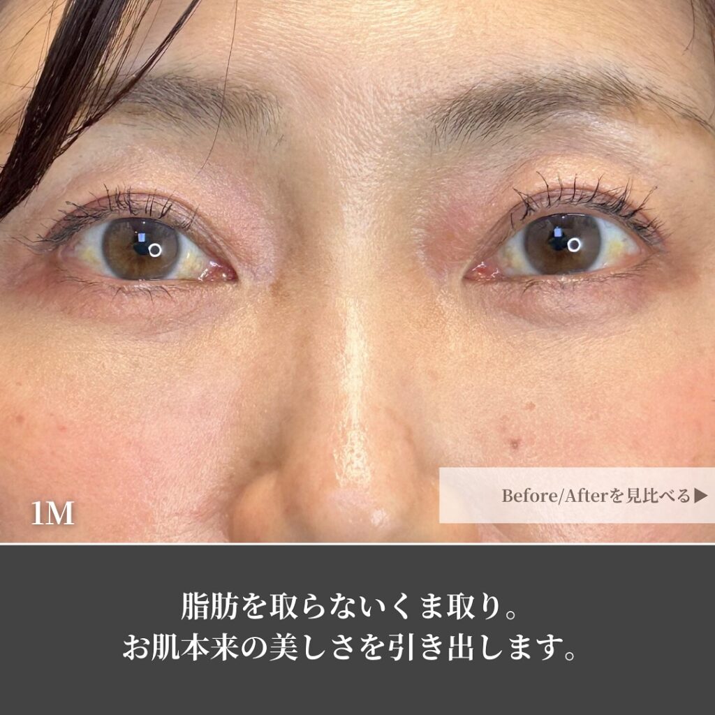 裏ハムラ法とナノリッチの症例写真 (9)