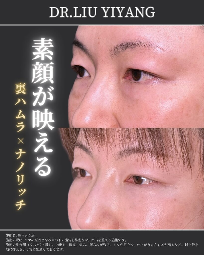 裏ハムラ法とナノリッチの症例写真 (26)