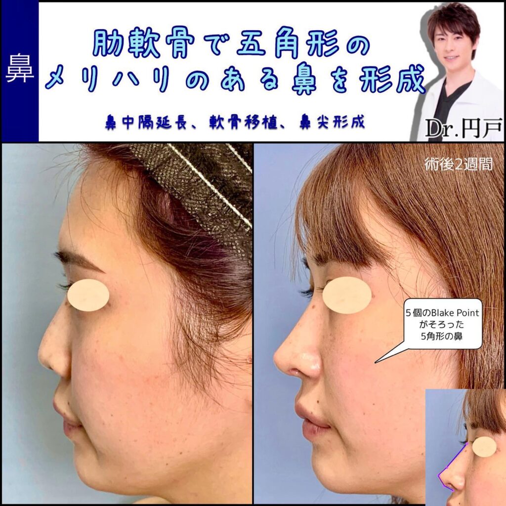 鼻中隔延長と軟骨移植と鼻尖形成の症例写真 (2)