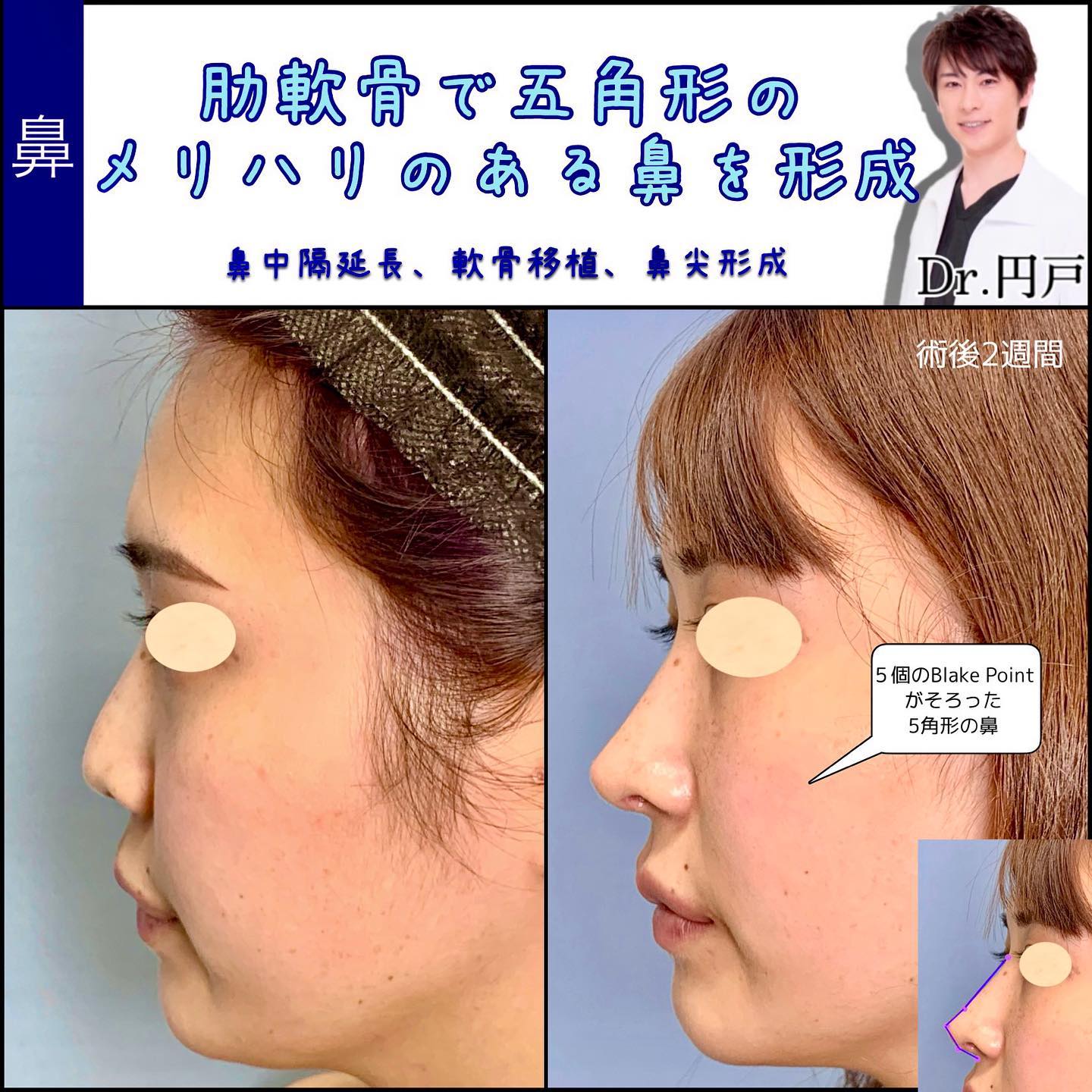 鼻中隔延長と肋軟骨移植と鼻尖形成の症例写真