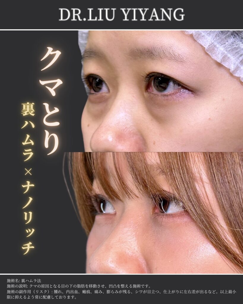 裏ハムラとナノリッチの症例写真 (9)