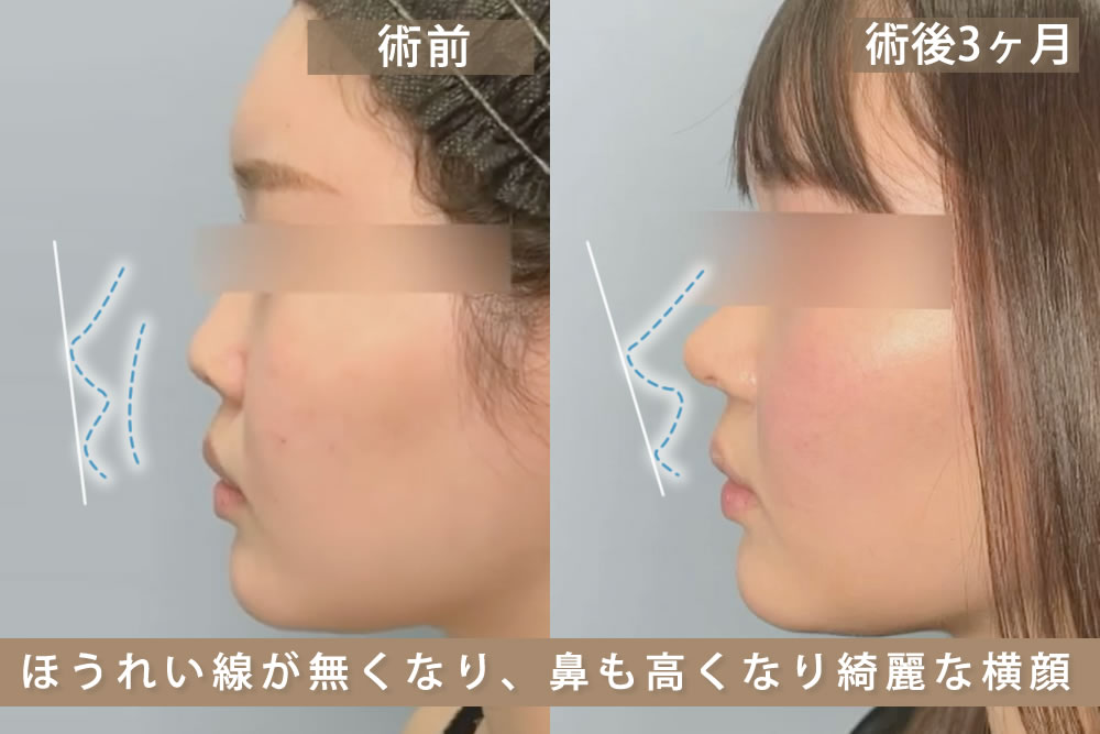 貴族手術の症例写真