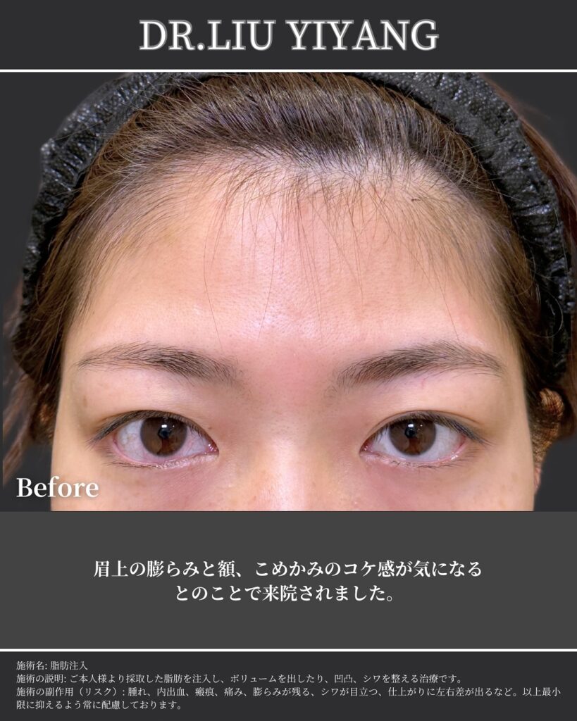 こめかみと額の脂肪注入の症例写真 (4)