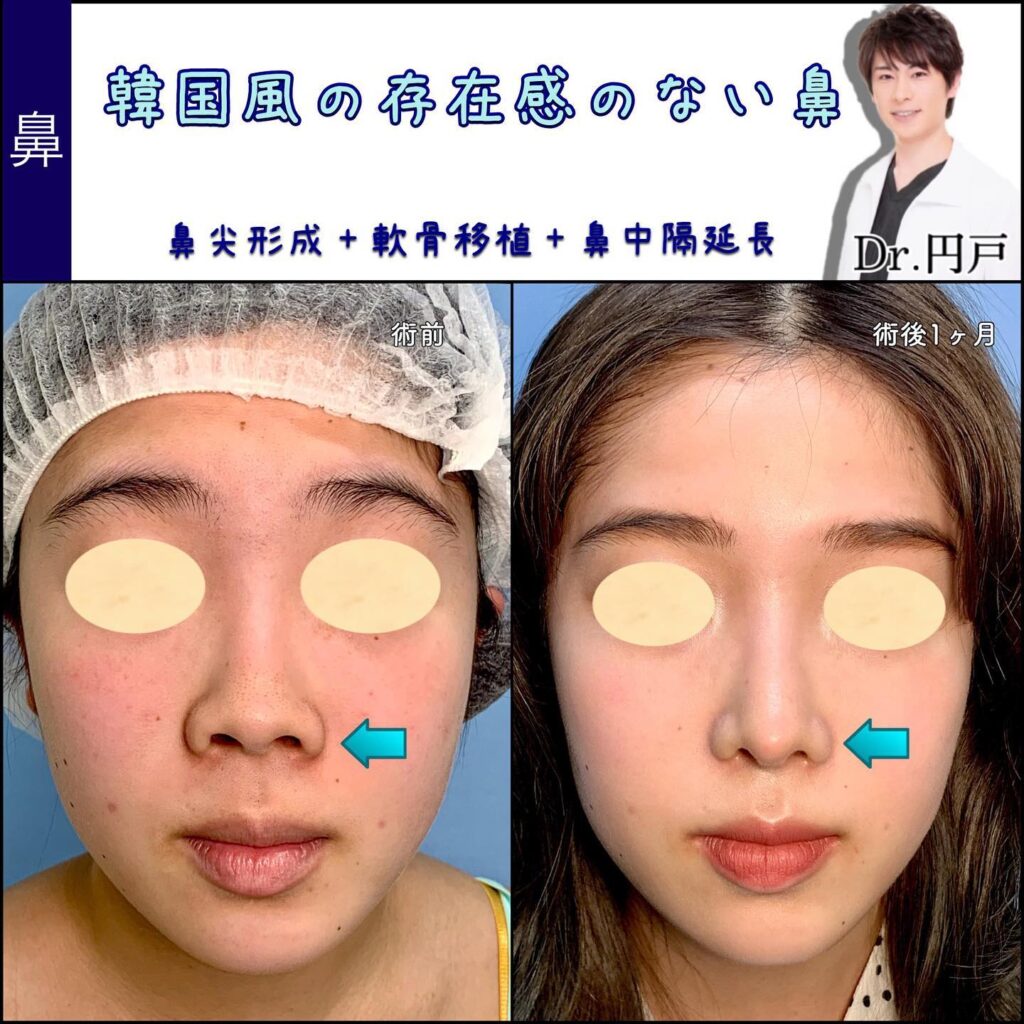 鼻尖形成と軟骨移植と鼻中隔延長の症例写真 (1)
