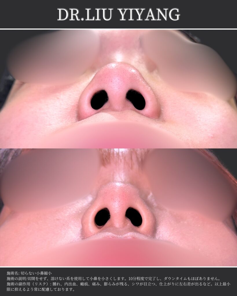 切らない小鼻縮小の症例写真 (1)
