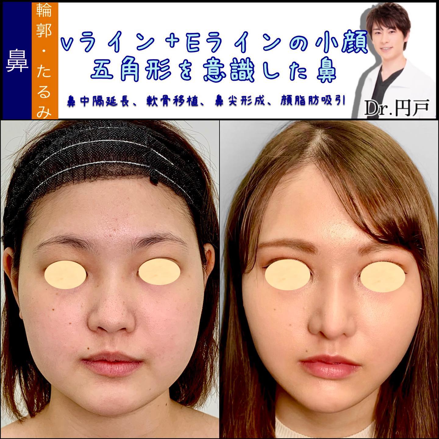 鼻中隔延長と軟骨移植と鼻尖形成と脂肪吸引の症例写真 (2)