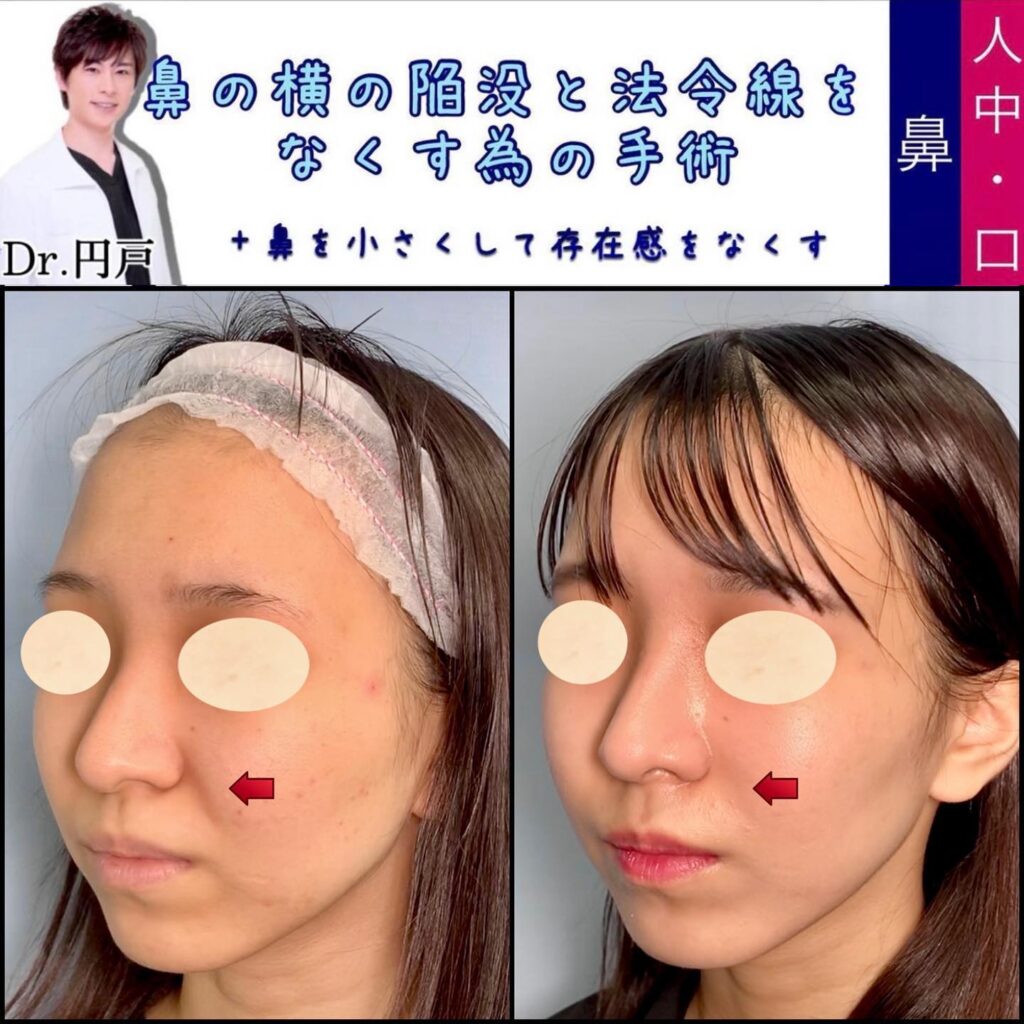 貴族手術(人工真皮) の症例写真 (3)