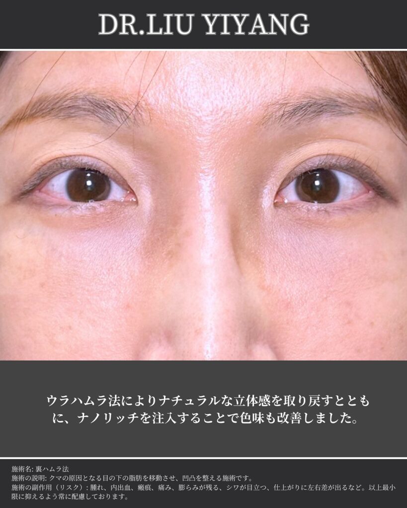 裏ハムラ法とナノリッチの症例写真 (36)