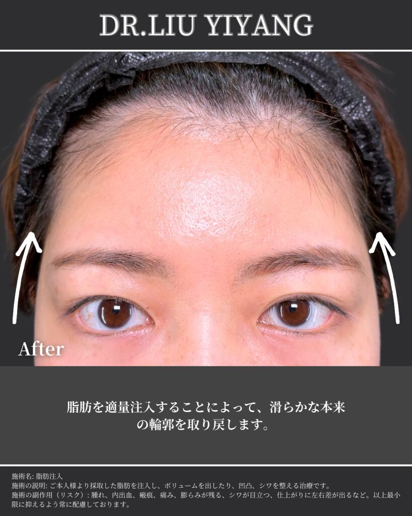 こめかみと額の脂肪注入の症例写真 (3)