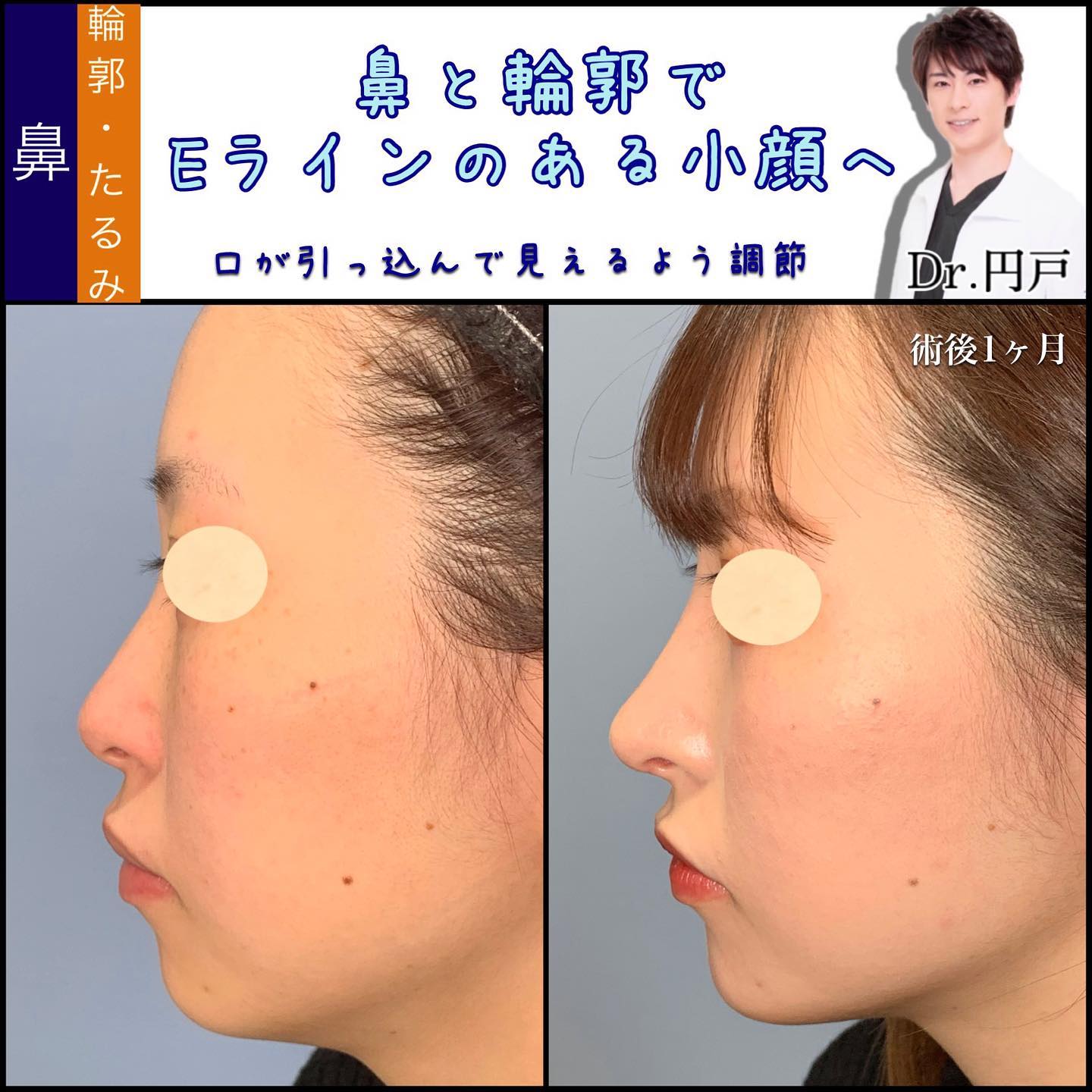 鼻中隔延長と鼻尖形成と軟骨移植と小鼻縮小とプロテーゼと小顔の脂肪吸引とバッカルファットと脂肪注入の症例写真 (3)