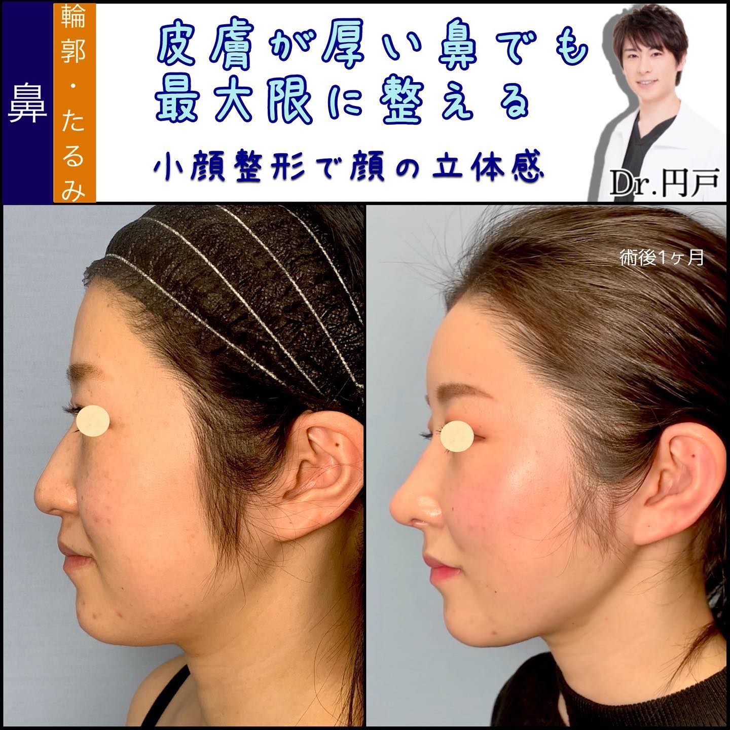 顔の脂肪吸引と脂肪注入と鼻中隔延長と軟骨移植と鼻尖形成と鼻背部軟骨移植と鷲鼻削りの症例写真