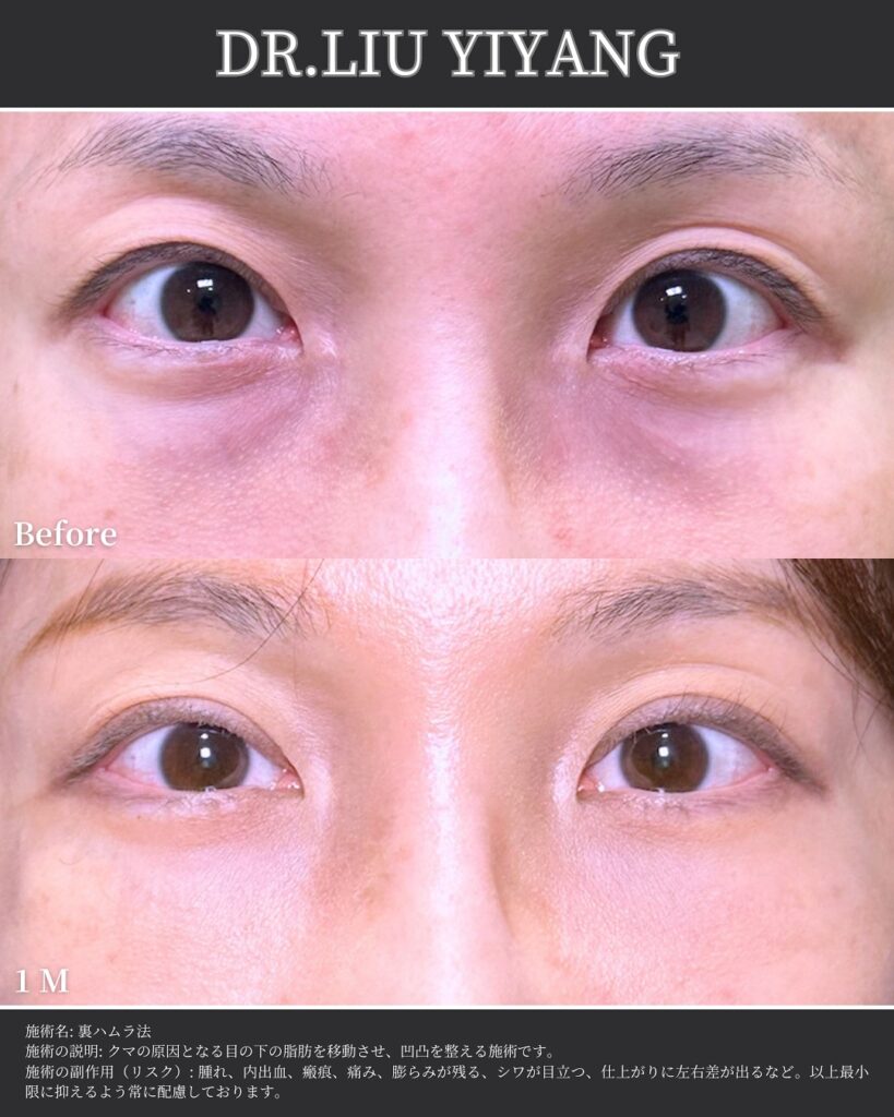 裏ハムラ法とナノリッチの症例写真 (34)