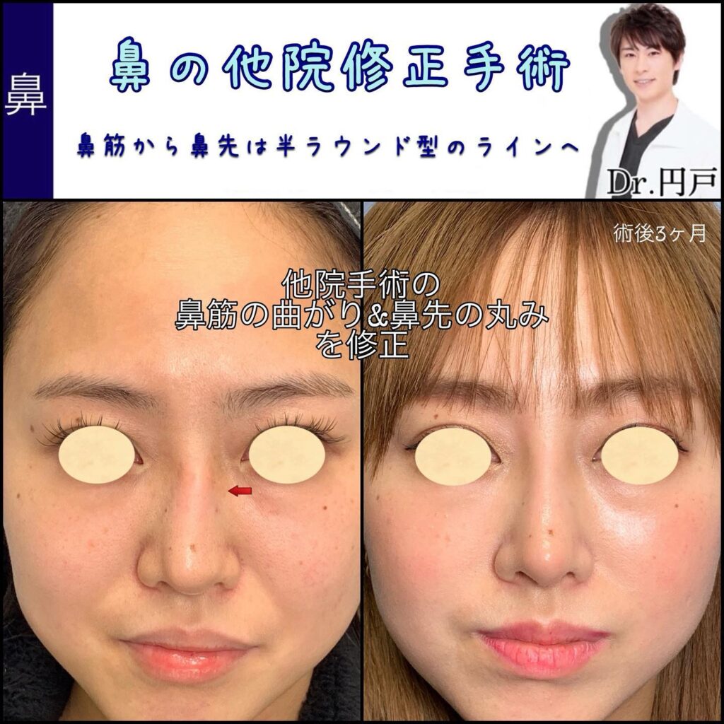 鼻の他院修正の症例写真 (2)