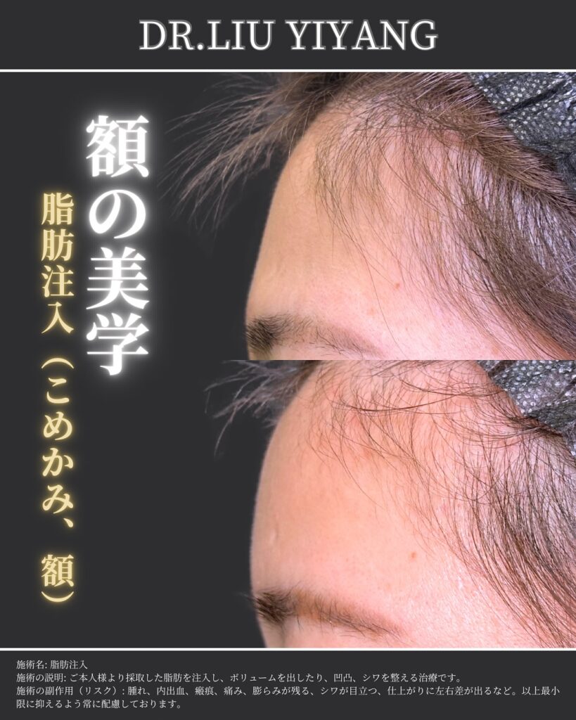 こめかみと額の脂肪注入の症例写真 (2)