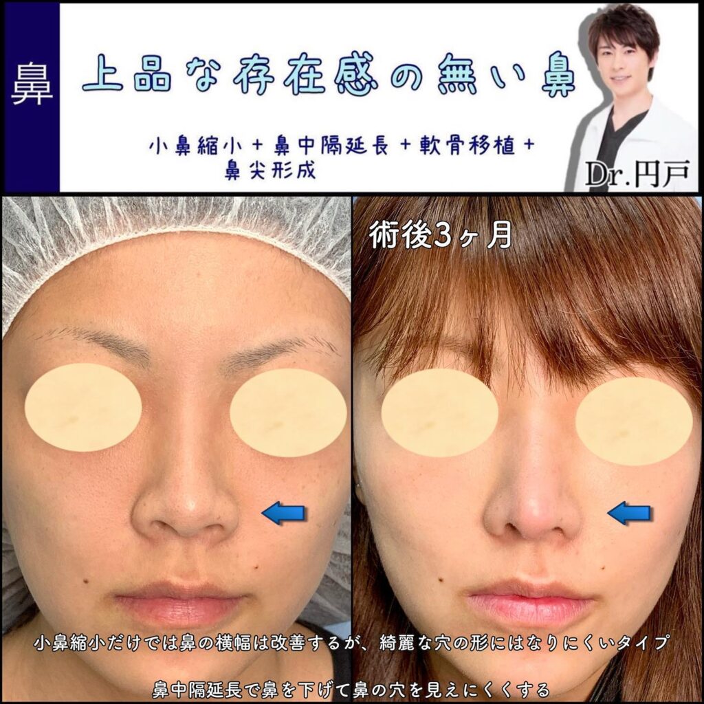 鼻中隔延長と軟骨移植と鼻尖形成の症例写真 (3)