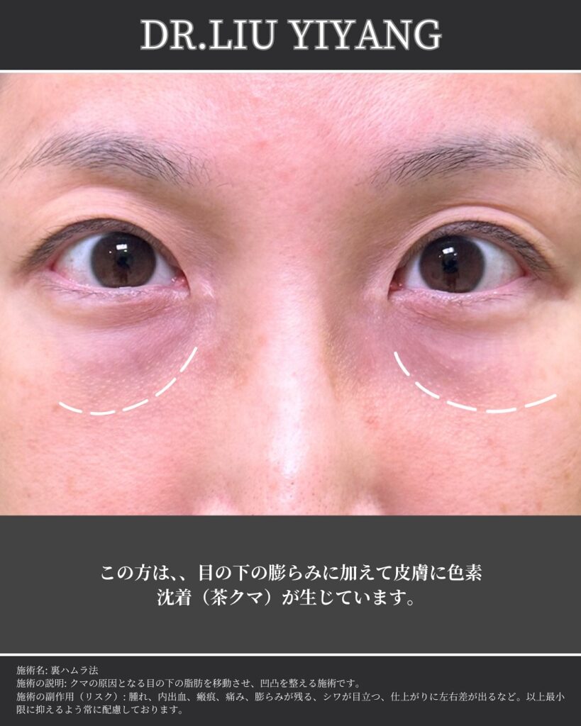 裏ハムラ法とナノリッチの症例写真 (37)