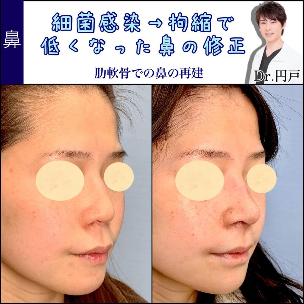 軟骨移植の症例写真