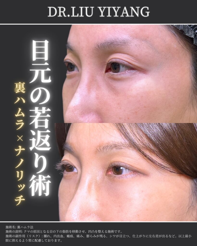 裏ハムラ法とナノリッチの症例写真 (38)
