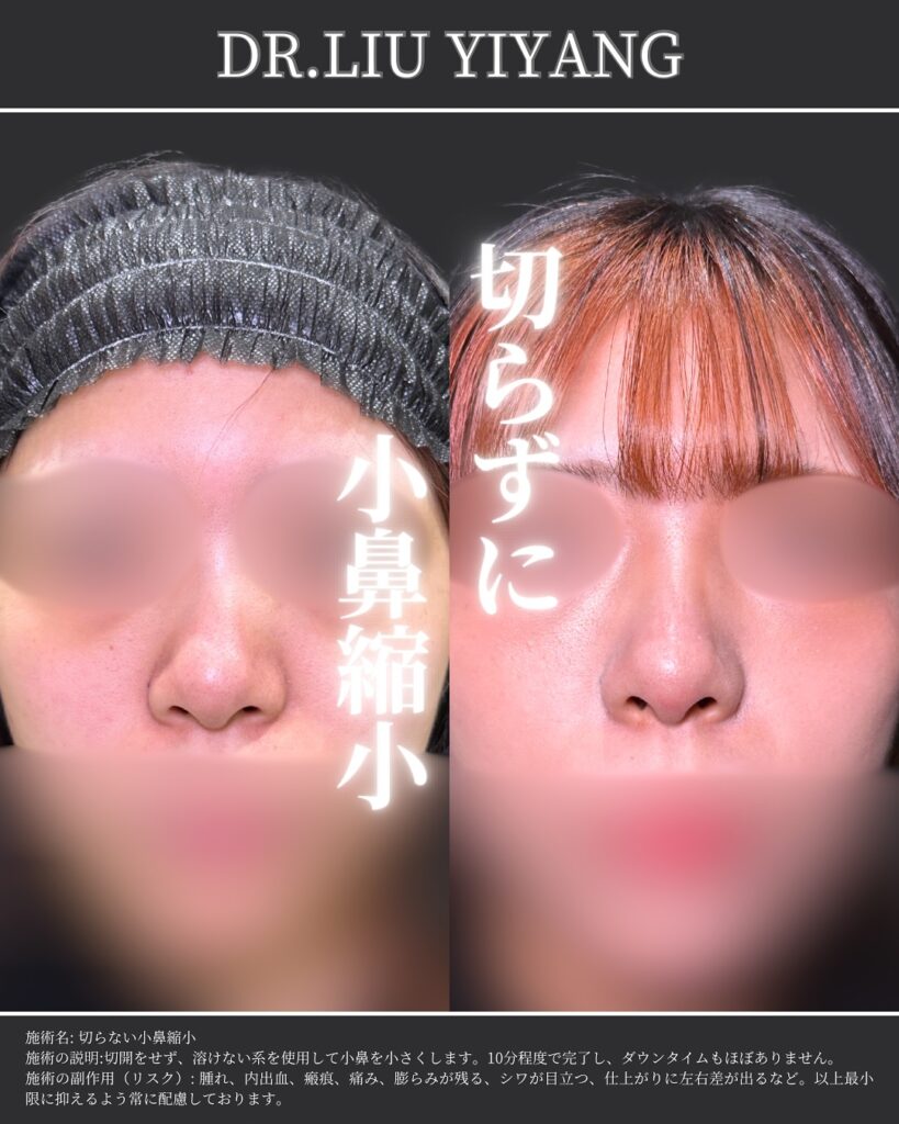 切らない小鼻縮小の症例写真 (2)