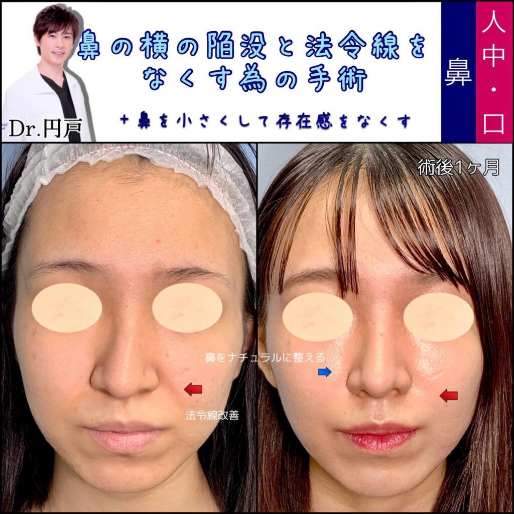 貴族手術(人工真皮) の症例写真 (2)
