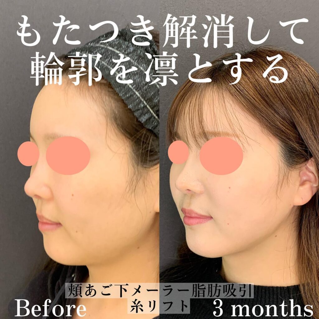 eclinicc新宿院の脂肪吸引症例写真