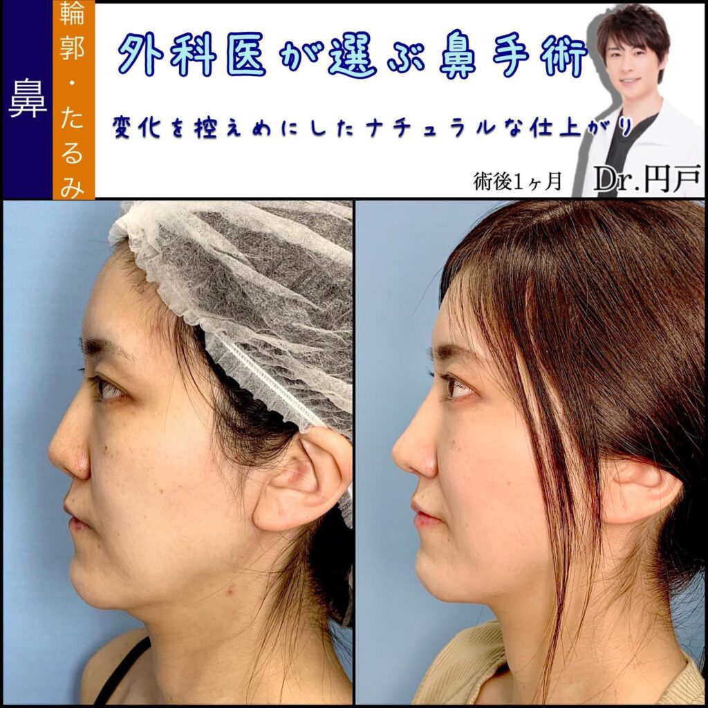 鼻中隔延長と軟骨移植と鼻尖形成と糸リフトと唇のヒアルロン酸の症例写真