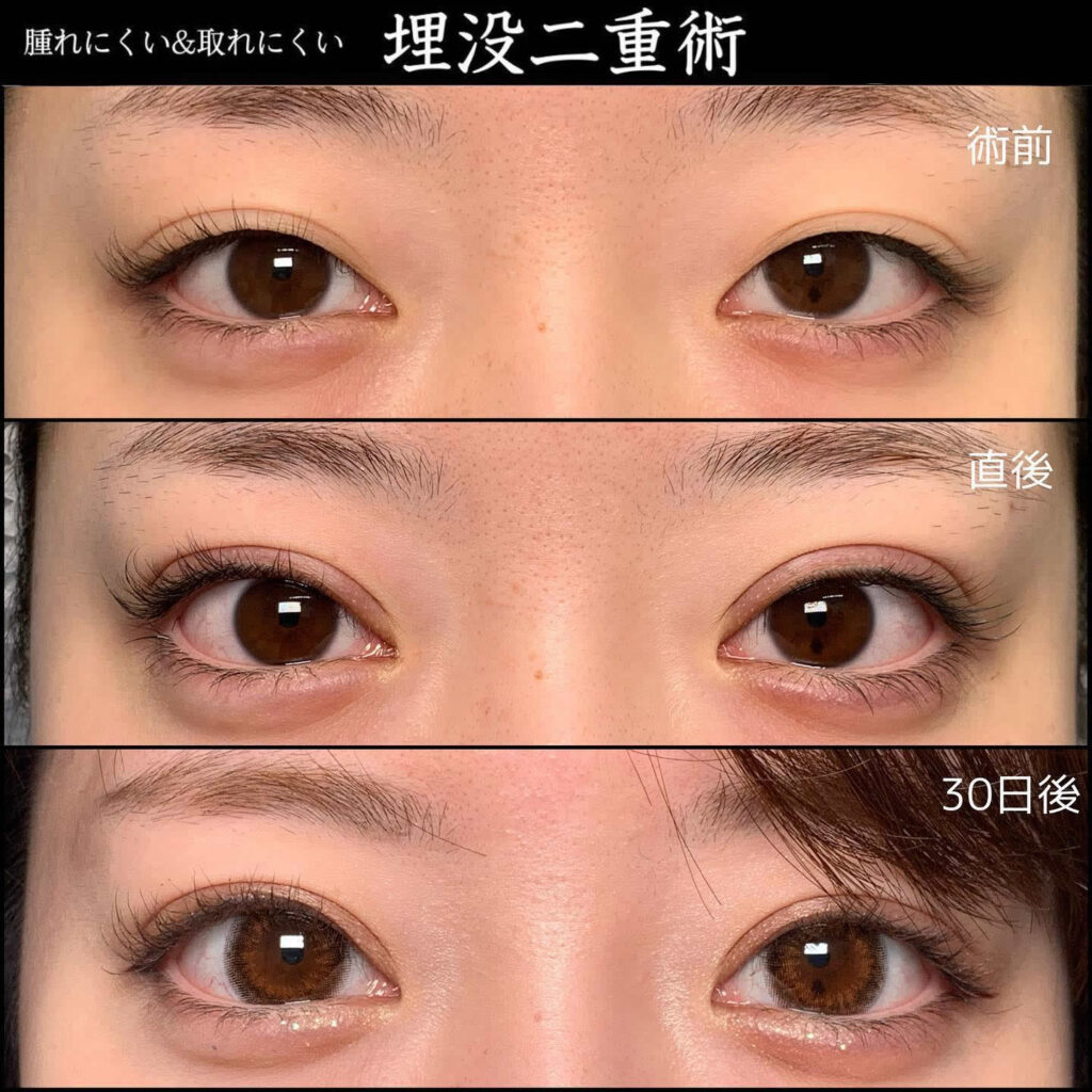 埋没法の直後と30日後の症例写真