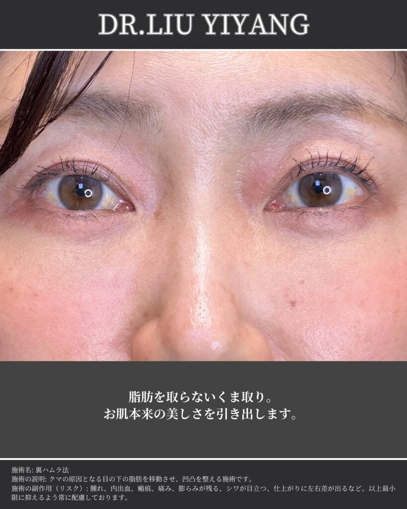 裏ハムラとナノリッチの症例 (2)