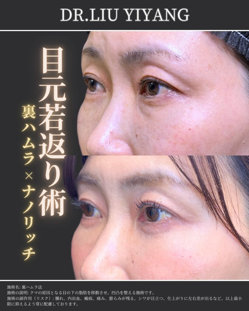 裏ハムラとナノリッチの症例 (1)