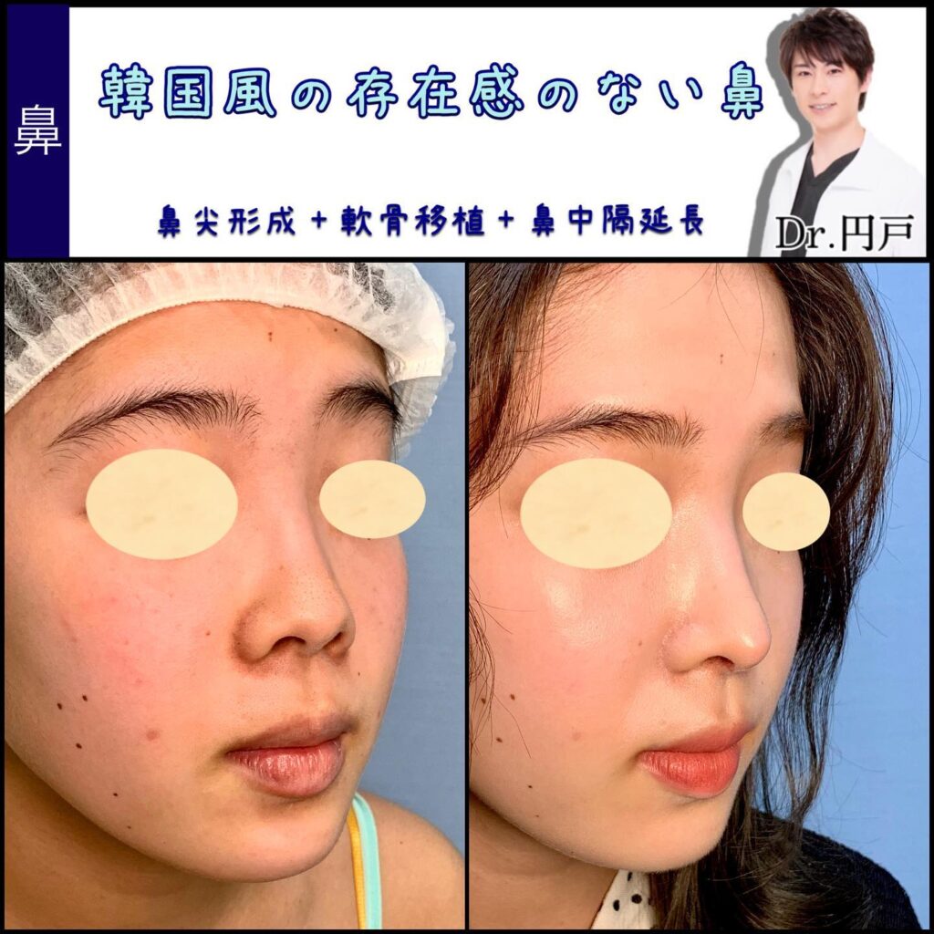 鼻尖形成と軟骨移植と鼻中隔延長の症例写真 (4)