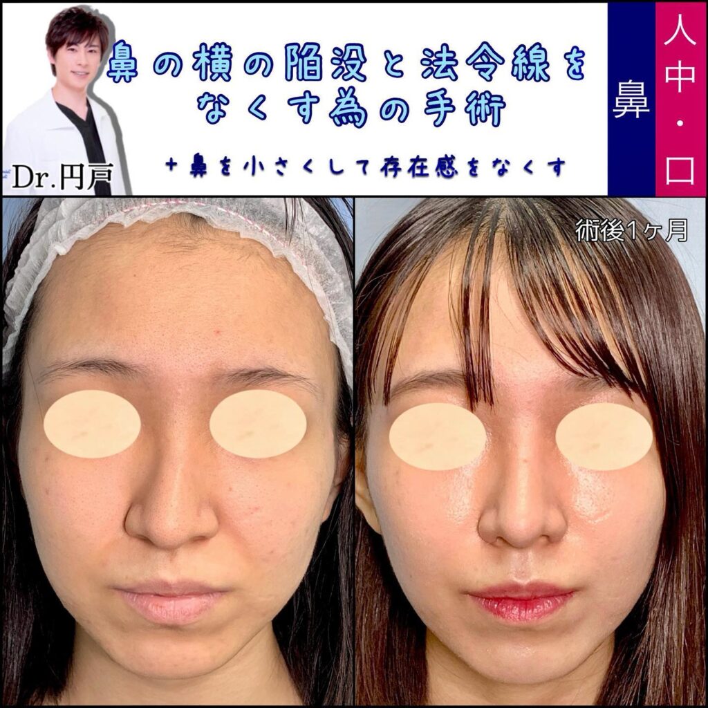 貴族手術(人工真皮) の症例写真 (1)