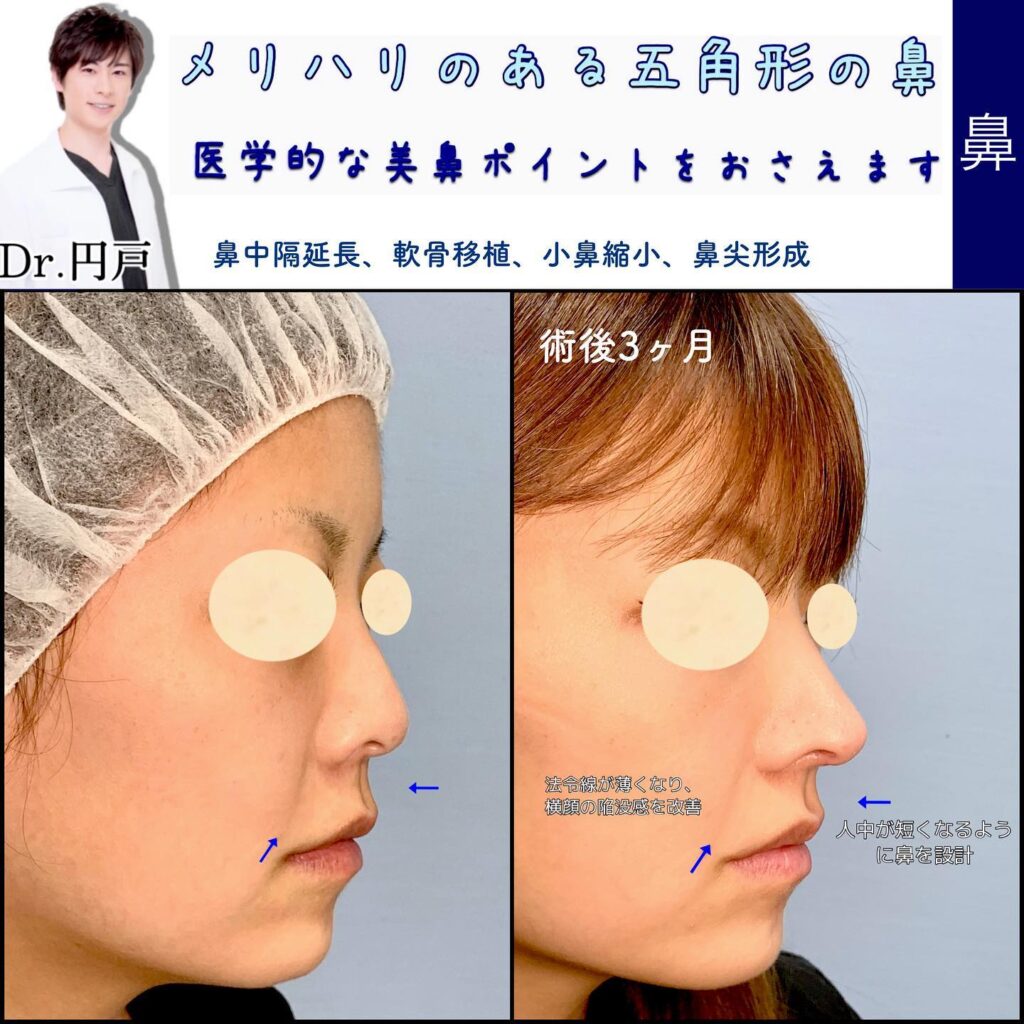 鼻中隔延長と軟骨移植と鼻尖形成の症例写真