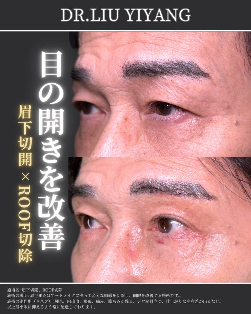 眉下切開の症例写真