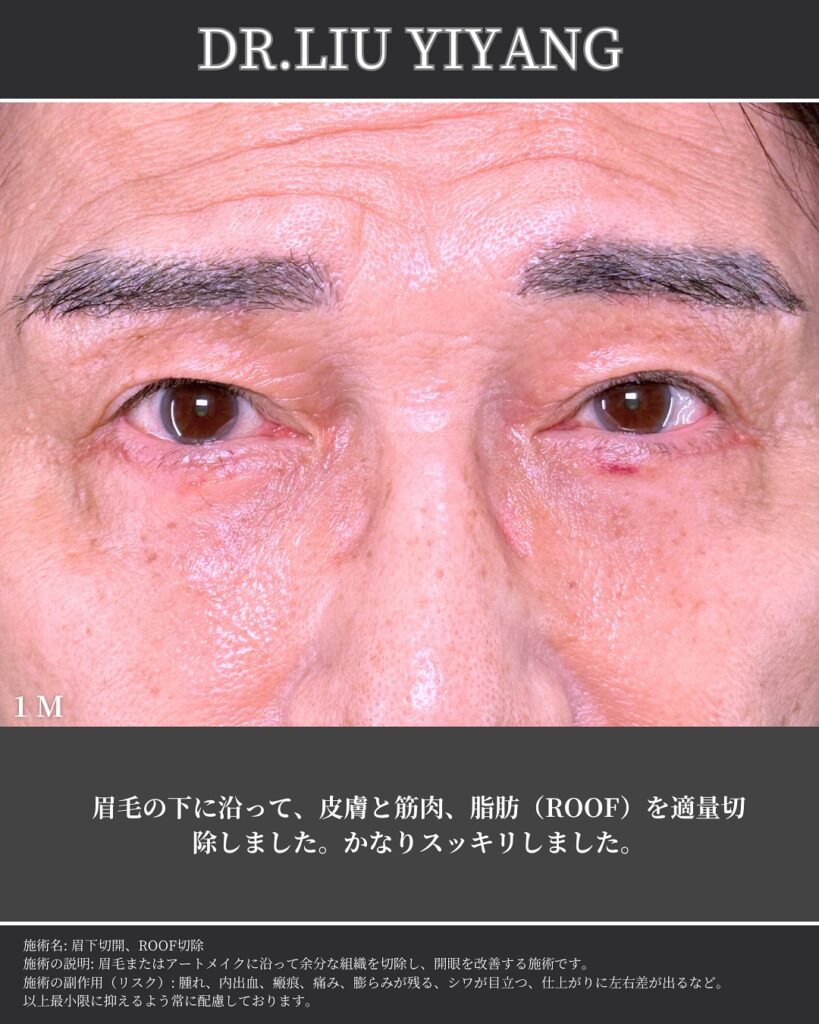 眉下切開の症例写真