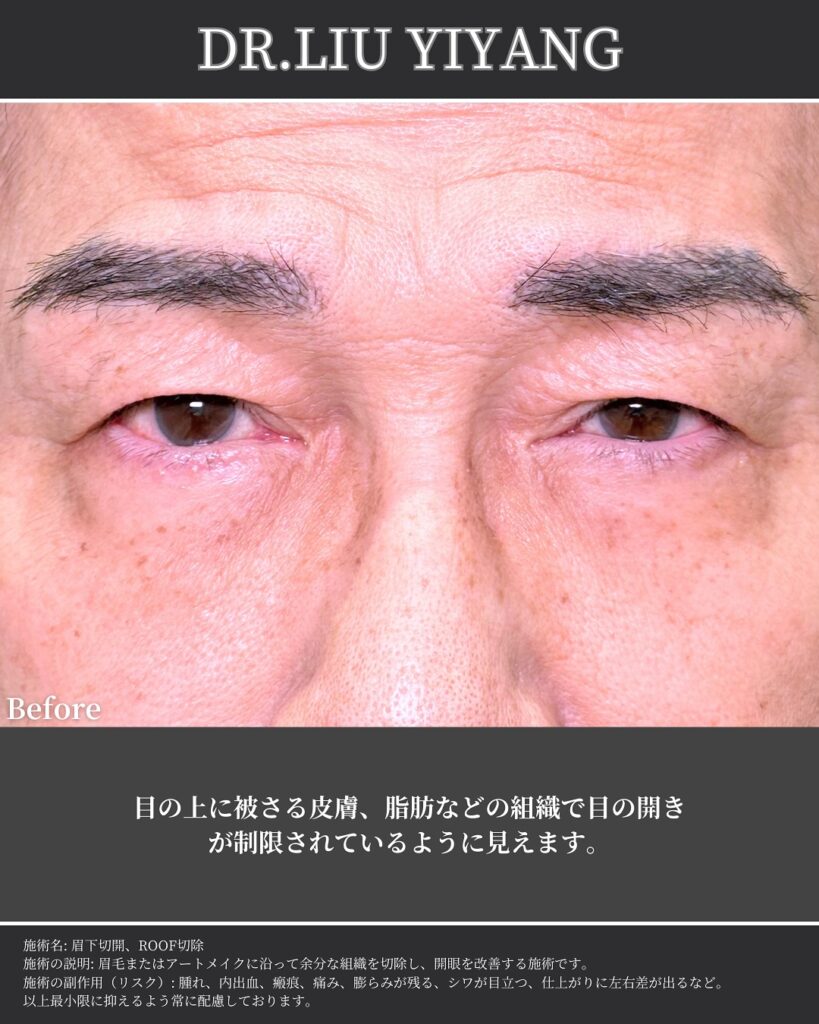 眉下切開の症例写真
