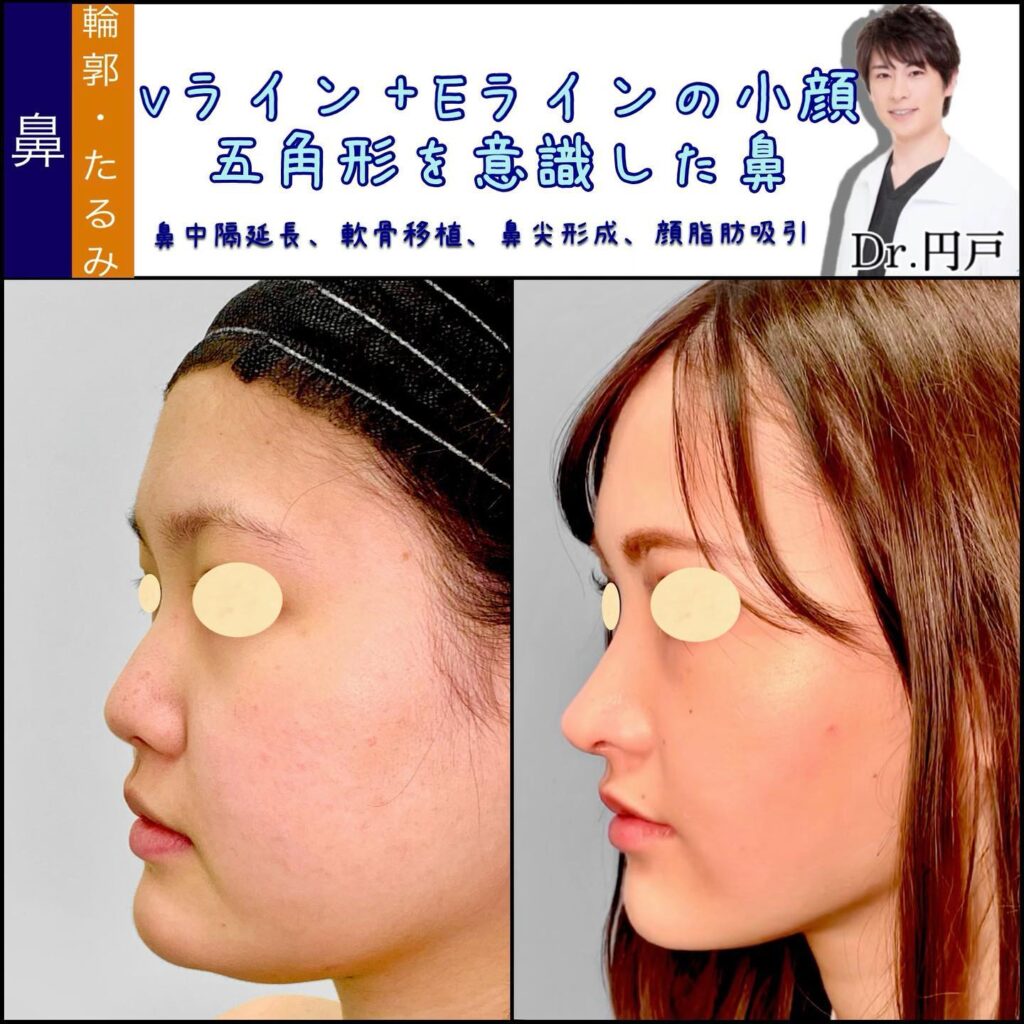 鼻中隔延長と軟骨移植と鼻尖形成と脂肪吸引の症例写真 (1)