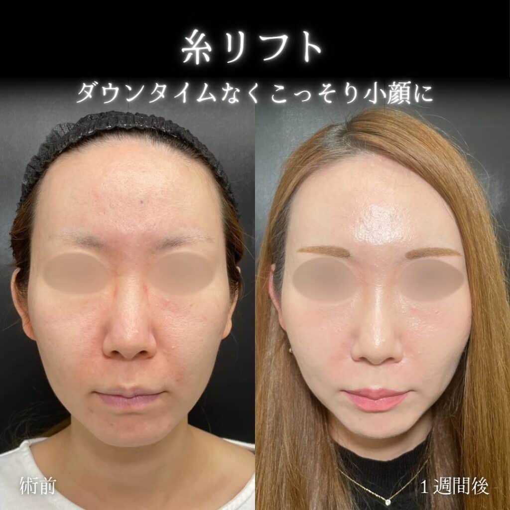 eclinic新宿院の糸リフト症例写真